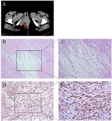 Comprehensive next-generation sequencing reveals low-grade fibromyxoid sarcoma of the vulva missed by morphological diagnosis: a case report